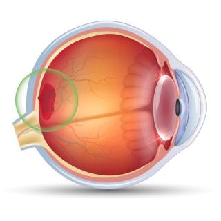 Диагностика и лечение заболеваний сетчатки глаза