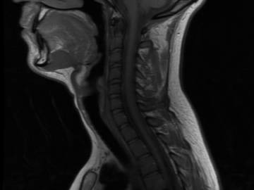 Мрт при остеохондрозе шейного отдела позвоночника
