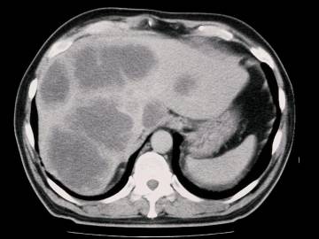 Компьютерная томография органов брюшной полости противопоказания