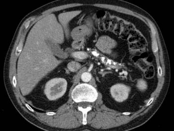 Компьютерная томография органов брюшной полости противопоказания