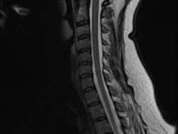 Мрт грудного отдела позвоночника может показать невралгию