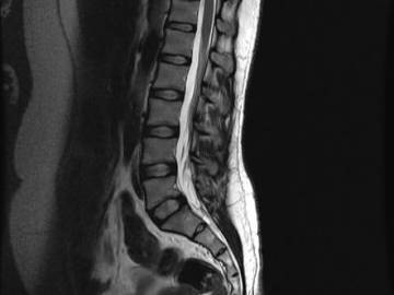 Мрт и кт спинного мозга