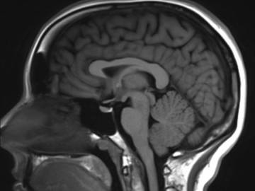 Рассеянный склероз на мрт головного мозга описание