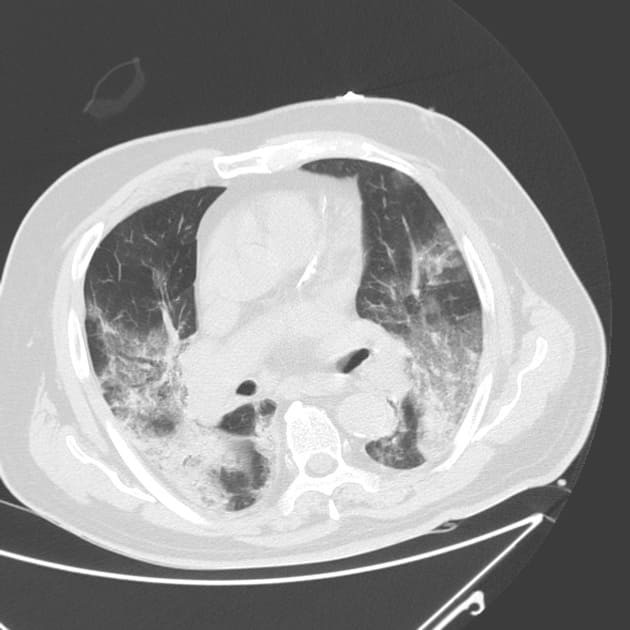 Рентген или кт при пневмонии thumbnail