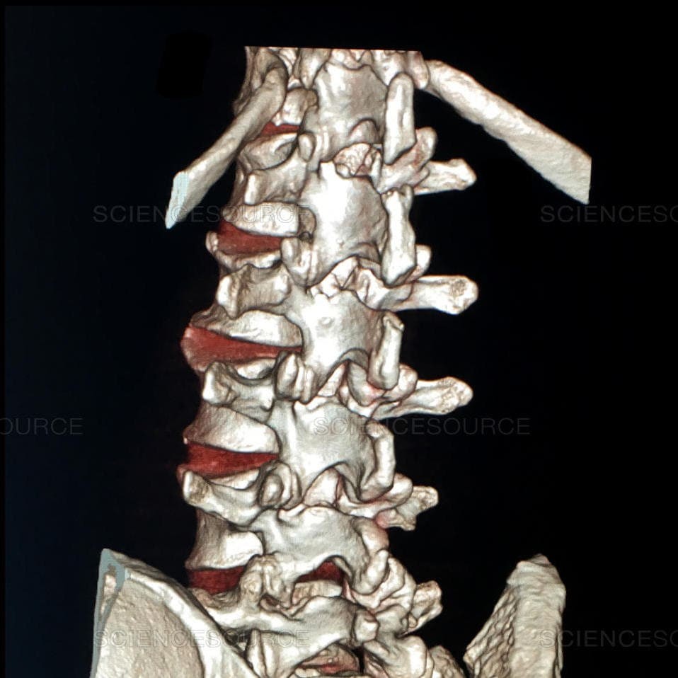 Все о КТ позвоночника - что покажет процедура, противопоказания, расшифровка