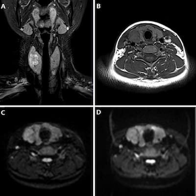 Узловой зоб щитовидной железы мрт. Кт при заболеваниях щитовидной железы. Делают ли кт щитовидной железы. Кистозная карцинома щитовидной железы кт. Зоб щитовидной железы кт.