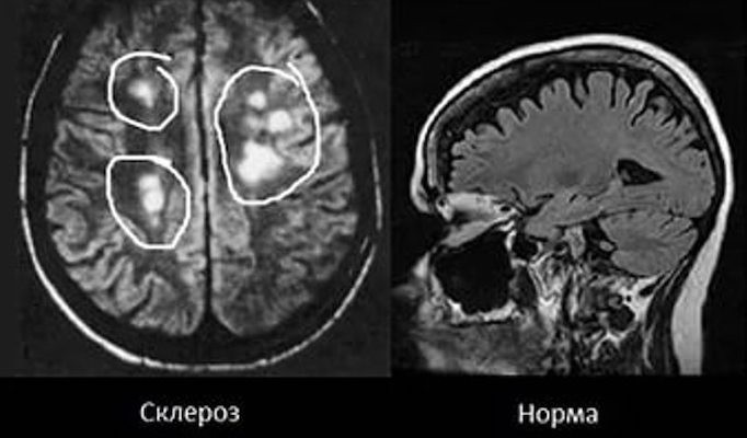 Норма и очаги рассеянного склероза на МРТ снимках