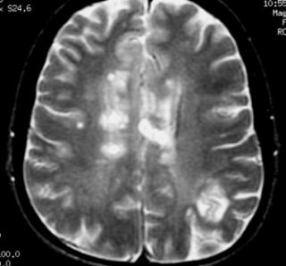 Рассеянный склероз на МРТ головного мозга