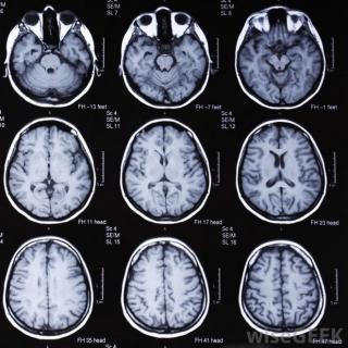 ЭЭГ или МРТ головного мозга - что выбрать?