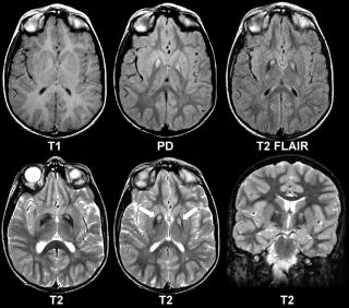 УЗИ или МРТ сосудов головного мозга - что лучше сделать?