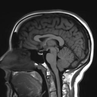 Покажет ли МРТ головного мозга опухоль