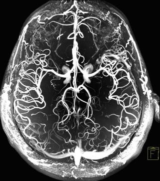 КТ или МРТ ангиография сосудов головного мозга - что лучше