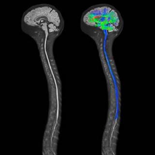 МРТ при опухоли спинного мозга и позвоночника