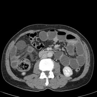 Что показывает компьютерная томография желудка и кишечника
